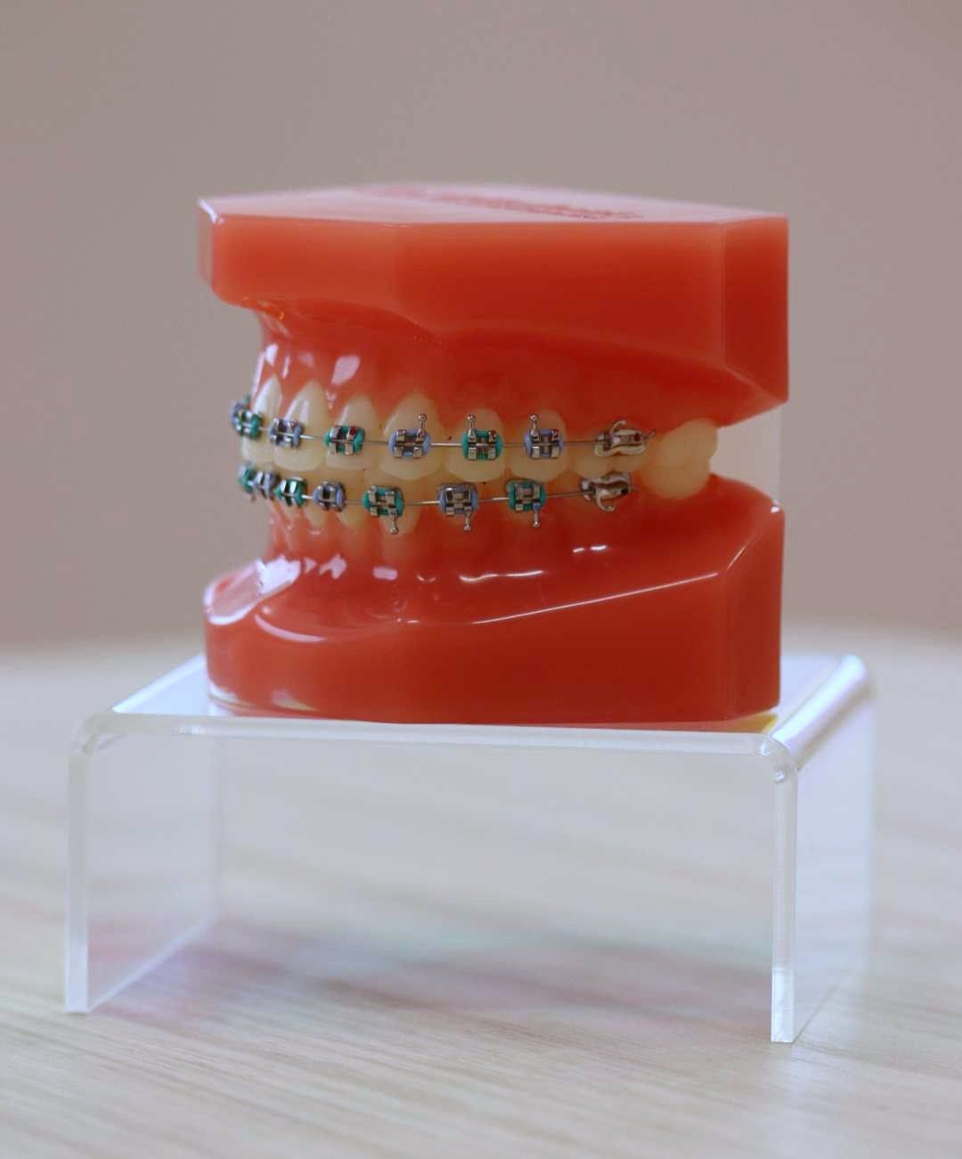 clear braces