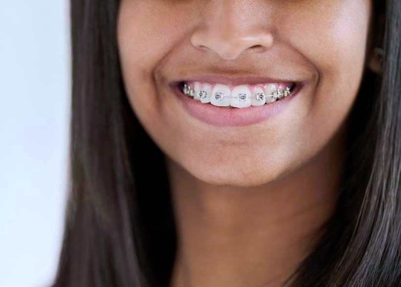 girl with metal braces